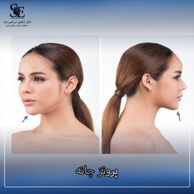 پروتز چانه - دکتر ابراهیم نژاد