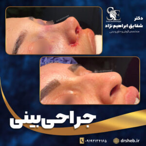 جراحی بینی نیمه فانتزی - دکتر ابراهیم نژاد