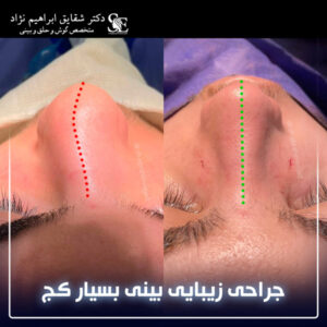 جراحی بینی کج - دکتر ابراهیم نژاد